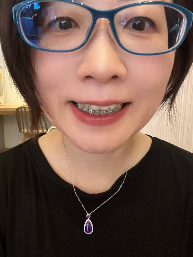 我天生牙齒就不好,所以更要小心堅果!